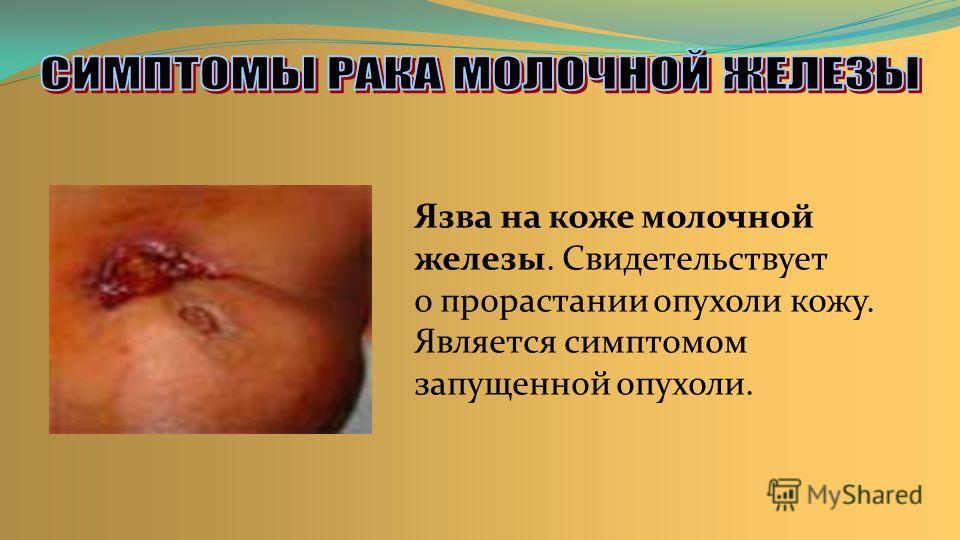 язва на коже язва на коже