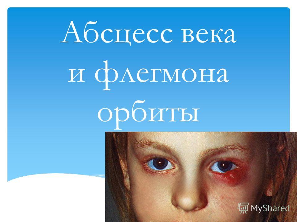 Абсцесс века - Арт Минск.ру