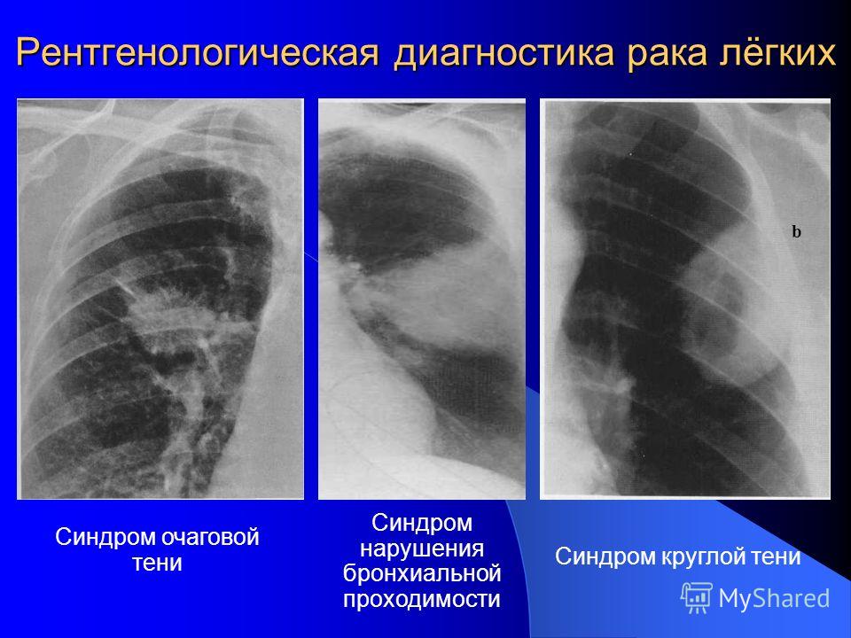 Как лечить нарушение бронхиальной проходимости Как лечить нарушение бронхиальной проходимости