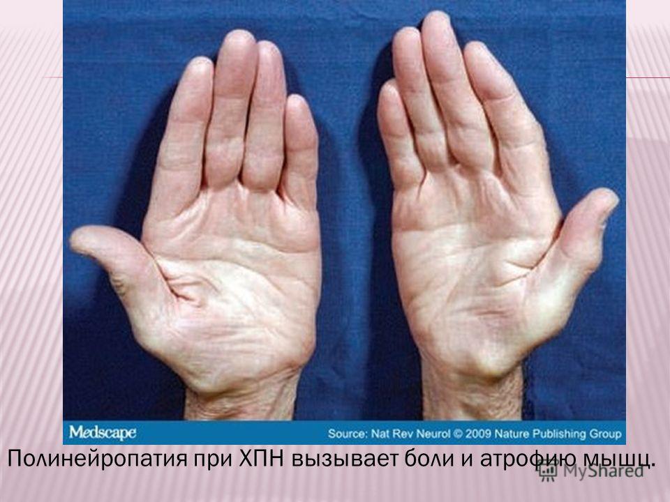 уремический запах изо рта уремический запах изо рта