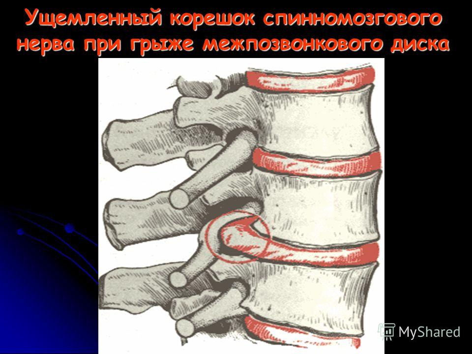 Головная боль и рвота при остеохондрозе Головная боль и рвота при остеохондрозе