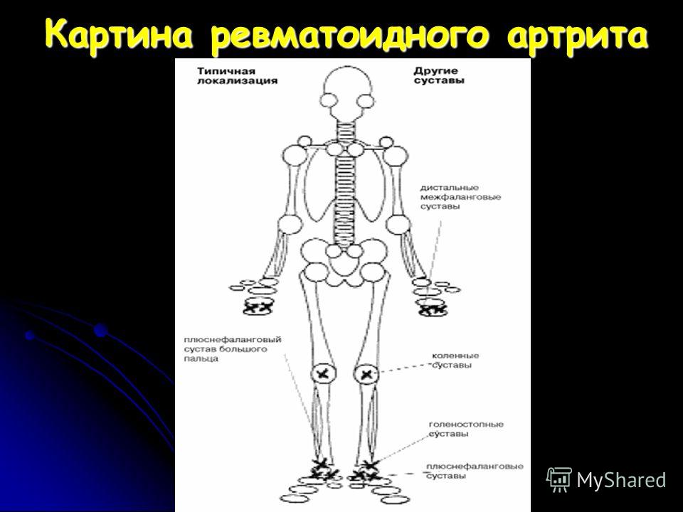 Алгоритм диагностики ревматоидного артрита