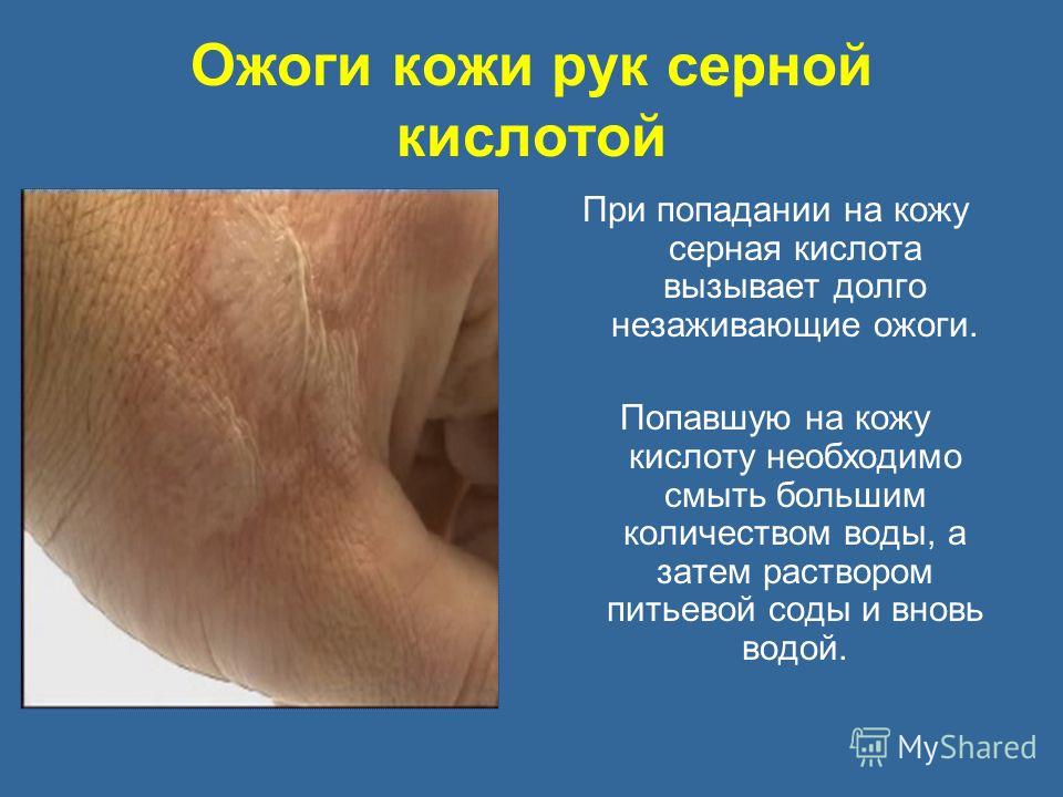 Серная кислота попала на кожу что делать