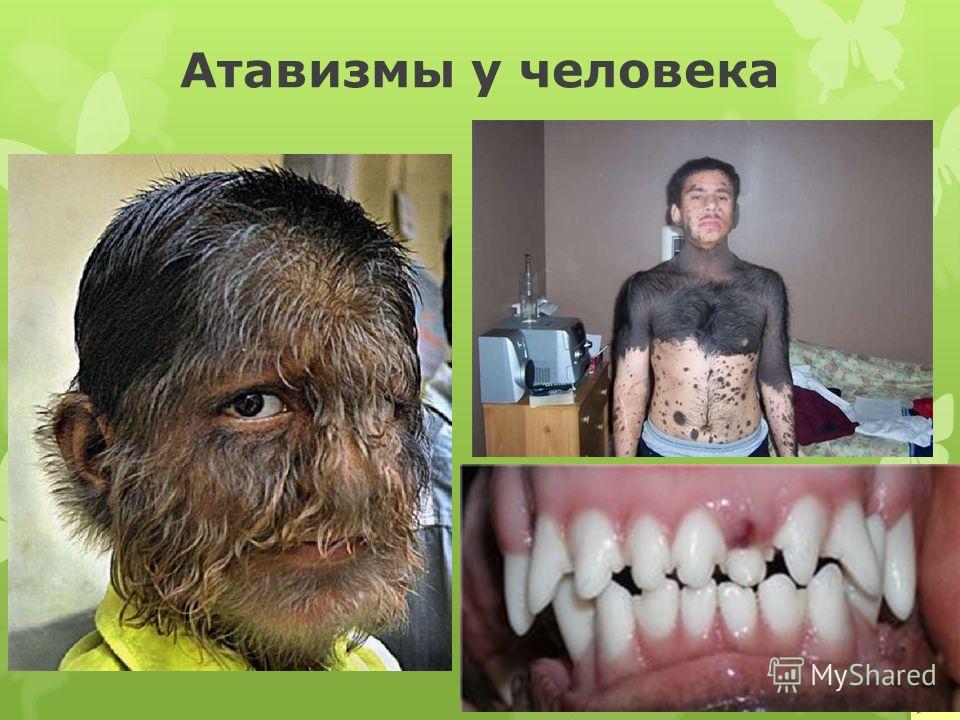 атавизмы у человека. фото онлайн атавизмы у человека. фото