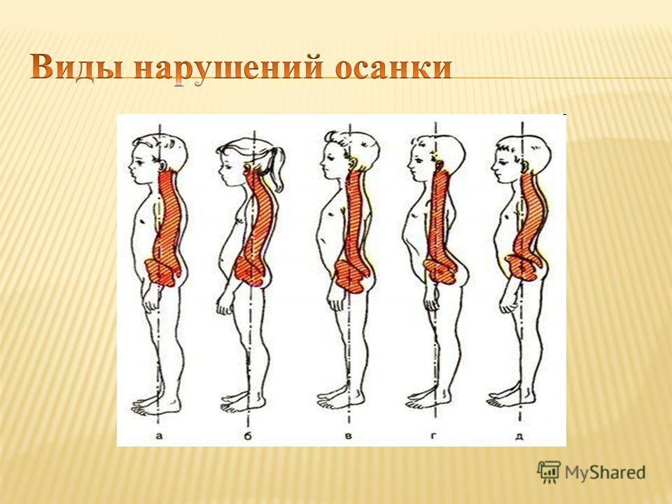 Лордоз шейного отдела лфк Лордоз шейного отдела лфк