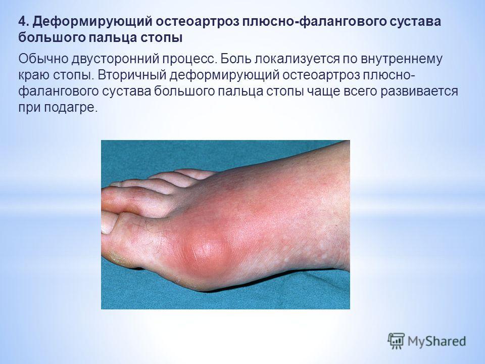 что такое доа сустава 3 степени что такое доа сустава 3 степени
