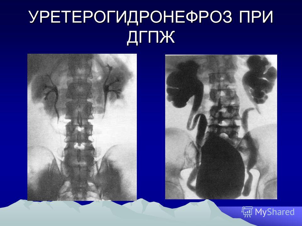 Оргазм Википедия Можно ли вылечить аденому простаты без операции? Вечные