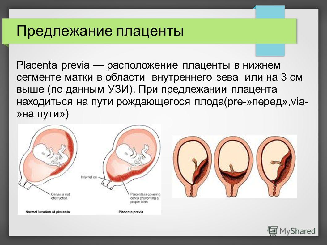Предлежание плаценты