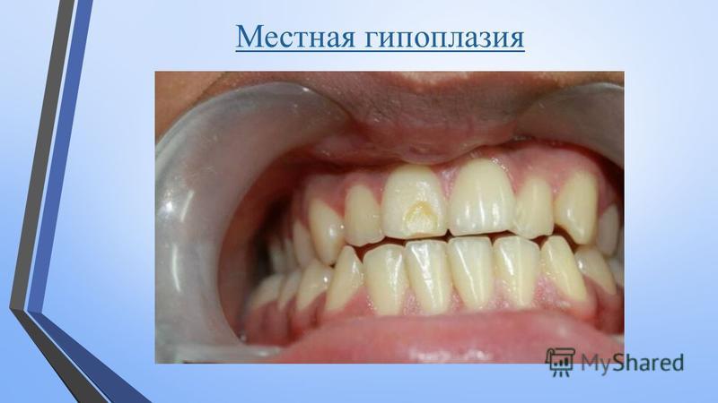 Гипоплазия головок бедренных костей. Строение бедренной кости Бедренная кость фото на теле Болезни клеточных органелл презентация, доклад