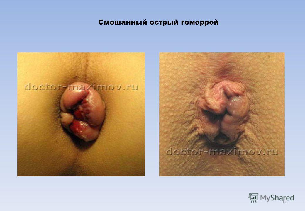Внутренний острый геморрой лечение