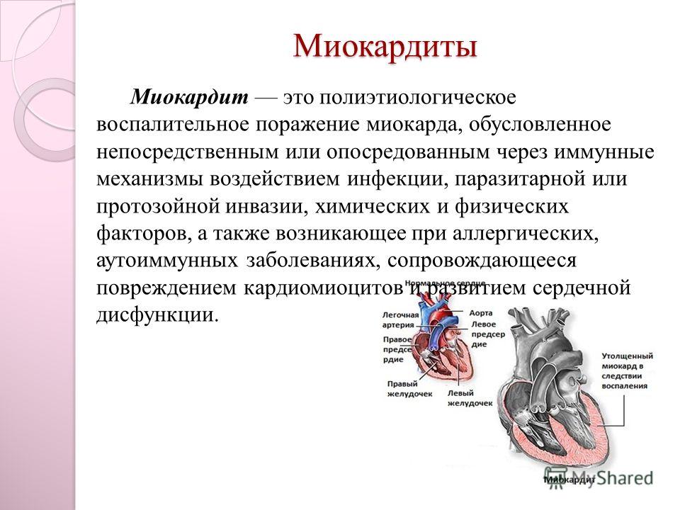 Поражение артритом сердца Поражение артритом сердца