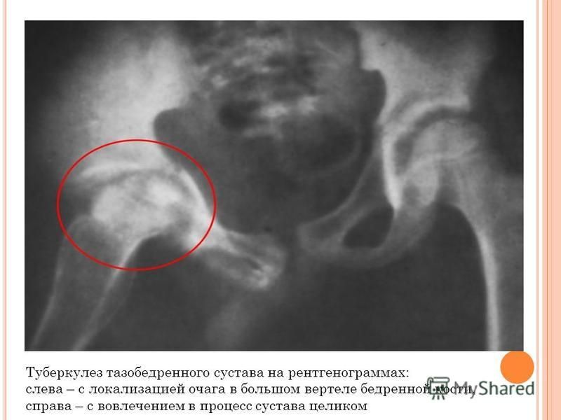 Туберкулез костей картинки