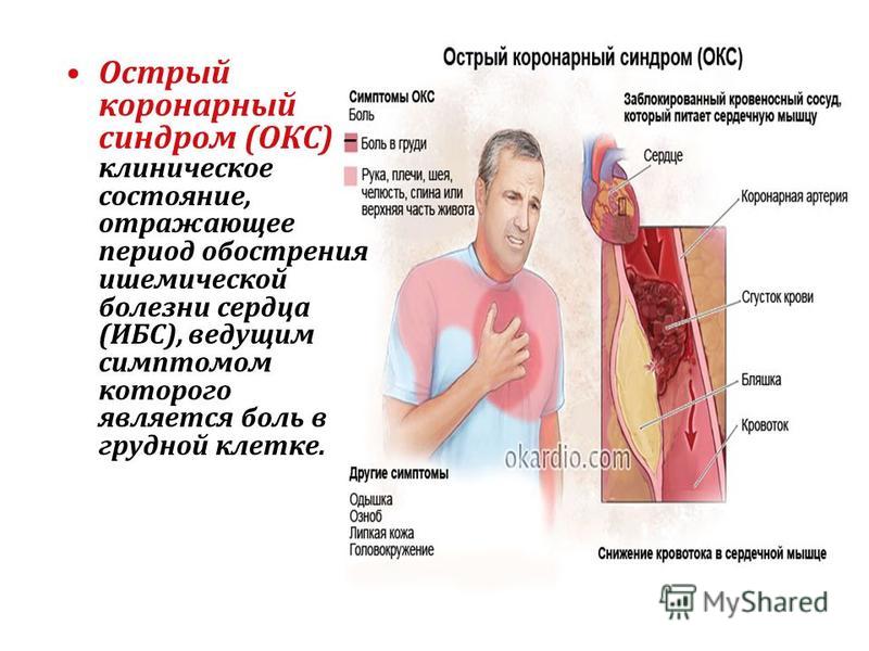 Острый коронарный синдром (ОКС) – клиническое состояние, отражающее период обострения ишемической болезни сердца (ИБС), ведущим симптомом которого является боль в грудной клетке.