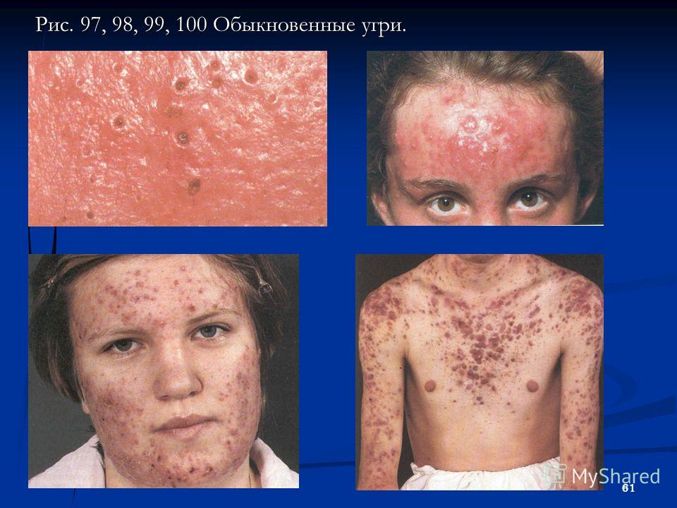 Как на лице давить угри на лице Как на лице давить угри на лице