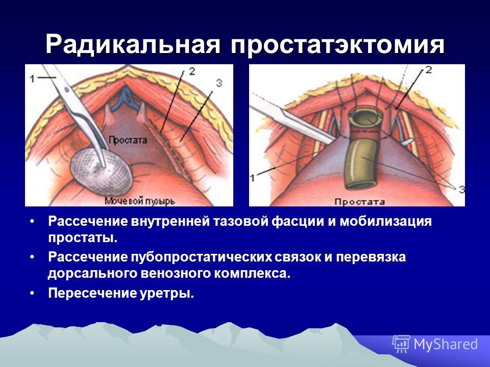 Болеутоляющие лекарства при простатите