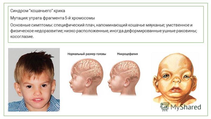 Презентация на тему синдром кошачьего крика