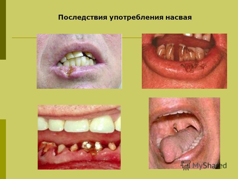 Бессонница вторые сутки - Нервные болезни