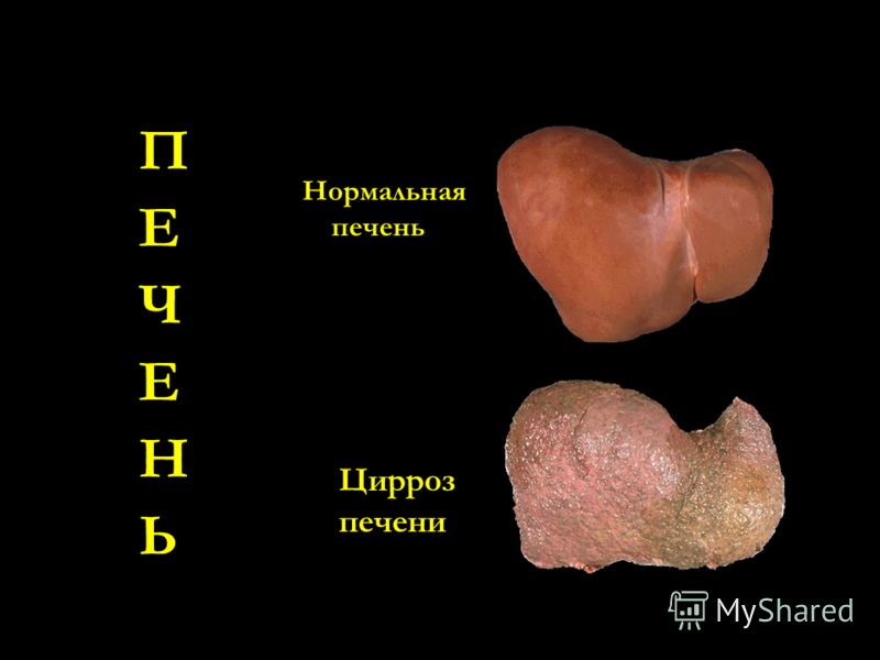 Нормальная печень Цирроз печени