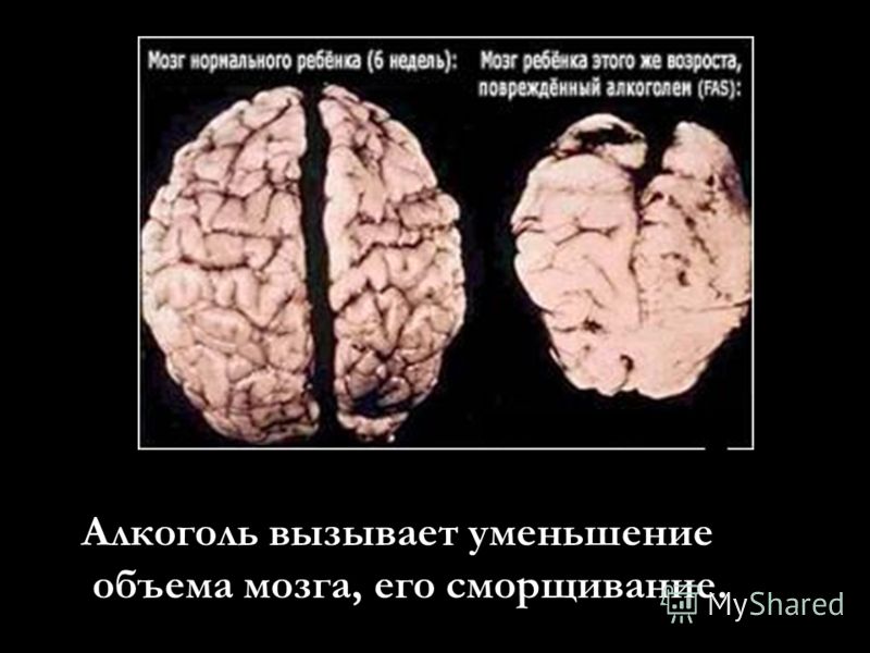 Алкоголь вызывает уменьшение объема мозга, его сморщивание.