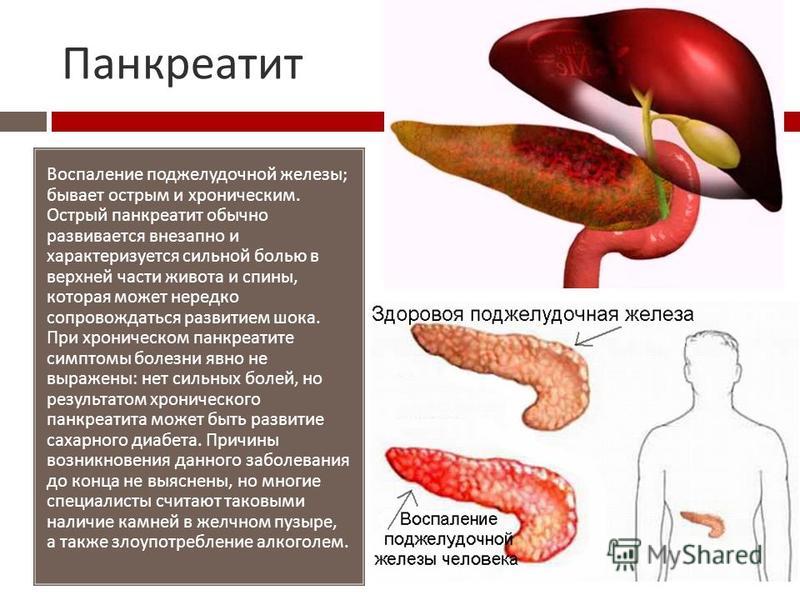 Поджелудочная Железа Воспаление Симптомы Диета